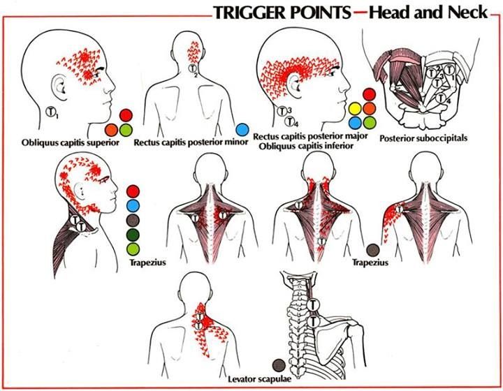 Headache - Trigger Points