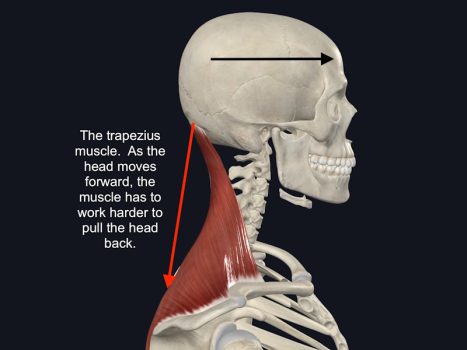Headache - Trapezius